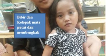Melisa Menanti Uluran Tangan Para Dermawan